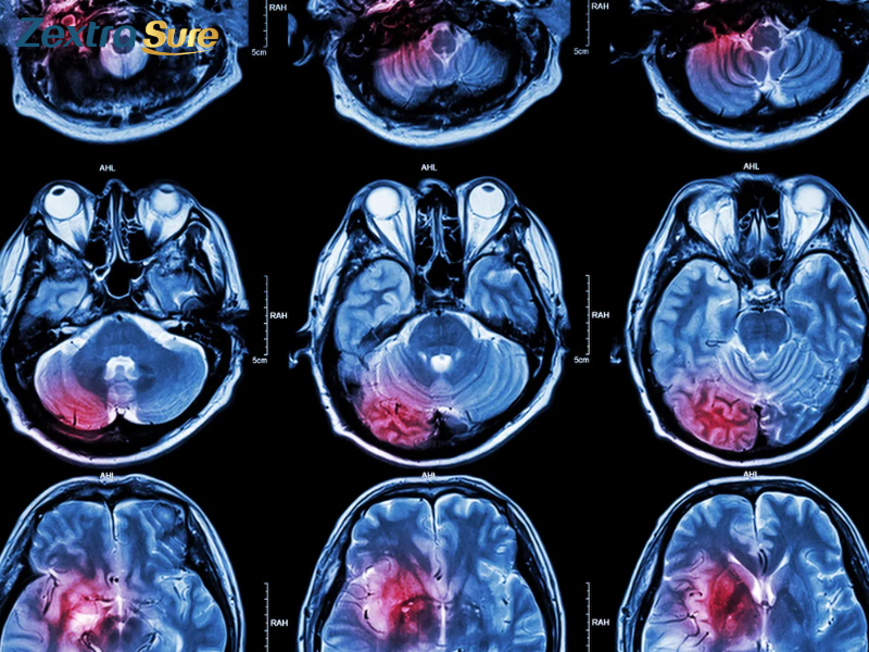 cerebellar-stroke (2)